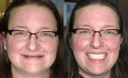 Custom-Fit Functional Dentures