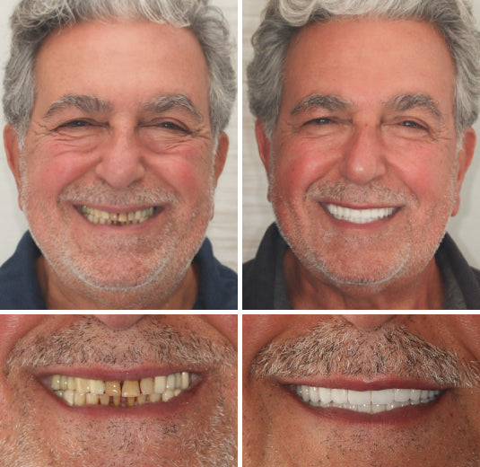 Custom-Fit Functional Dentures
